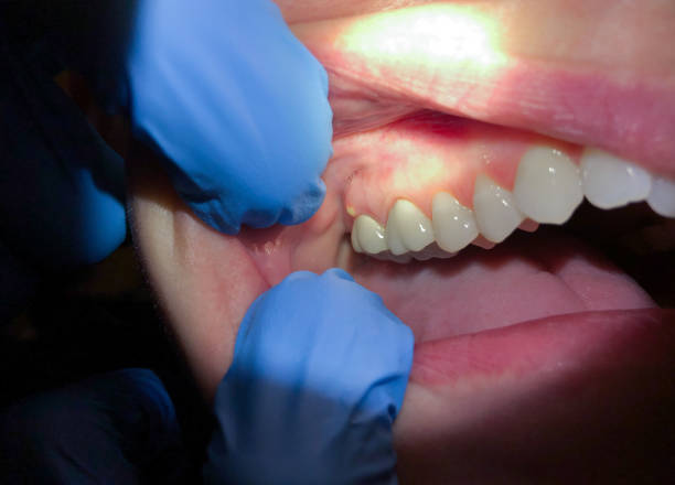 Best Emergency Tooth Extraction in Soh Jordan, UT